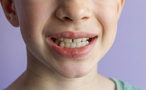 Ilustrasi Gigi Anak Tonggos. Foto: Shutterstock
