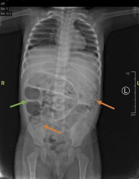 Cacing yang berada di usus anak berusia 3 tahun asal Jember. Foto: Dok. Journal of Medical Case Reports