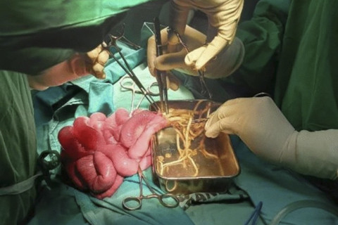 Cacing yang berada di usus anak berusia 3 tahun asal Jember. Foto: Dok. Journal of Medical Case Reports