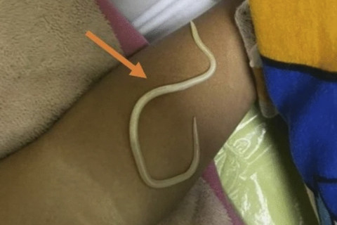 Cacing yang berada di usus anak berusia 3 tahun asal Jember. Foto: Dok. Journal of Medical Case Reports