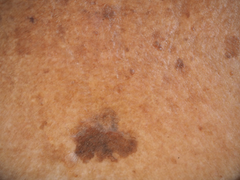 Ilustrasi neurofibromatosis. Foto: jaojormami/Shutterstock