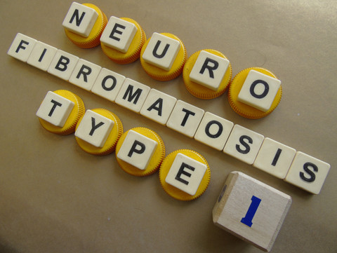 Ilustrasi neurofibromatosis. Foto: Mamat Suryadi/Shutterstock