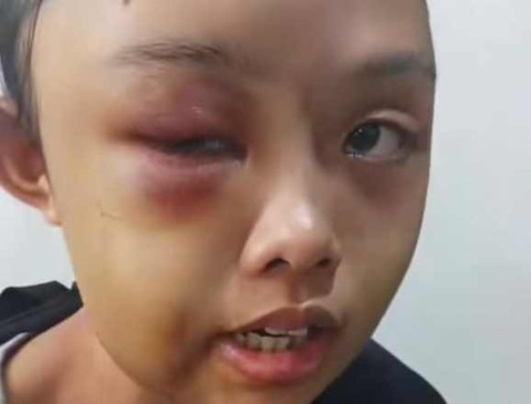 Wajah VW babak belur dianiaya tante. Dok: Ist.