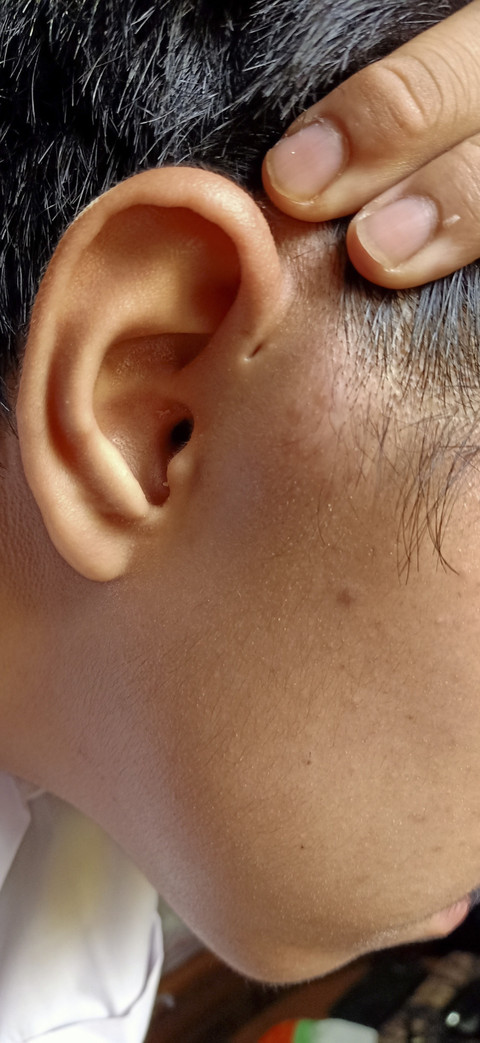 Ilustrasi Sinus Preauricular. Foto: Shutterstock