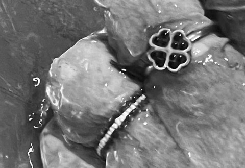 Cincin di jari korban mutilasi Sumbar. Dok: kumparan