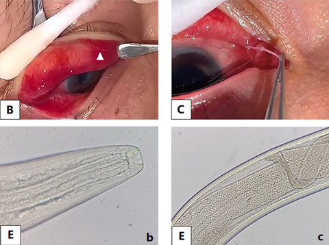 Mata seorang wanita di China menjadi sarang cacing parasit. Foto: BMC Ophthalmology