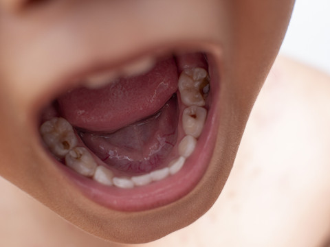Ilustrasi karies gigi pada anak. Foto: Maule/Shutterstock
