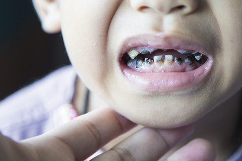 Ilustrasi karies gigi pada anak. Foto: Noppadon stocker/Shutterstock