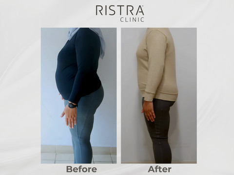 Tampilan sebelum dan sesudah di area seluruh badan. Foto: Dok. Ristra Clinic