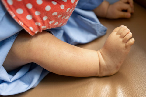 Ilustrasi cutis marmorata. Foto: Chatchai.wa/Shutterstock