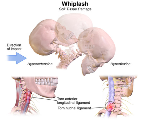 Ilustrasi whiplash. Foto: Dok. Donald Physiotherapy