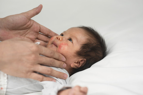 Ilustrasi kulit bayi ruam atau kemerahan. Foto: Shutterstock