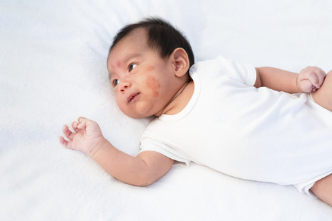 Ilustrasi kulit bayi ruam atau kemerahan. Foto: Shutterstock