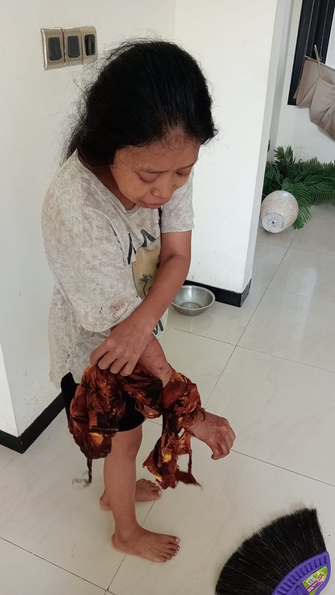 Warga yang mengalami lukas akibat digigit Owa Jawa lepas kandang di Surabaya. Foto: DPKP Kota Surabaya