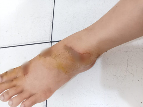 Kondisi luka siswi kelas 3 sekolah dasar yang terseret pelaku pencurian sejauh 20 meter, Medan, Selasa (13/1/2026). Foto: Dok. Pribadi