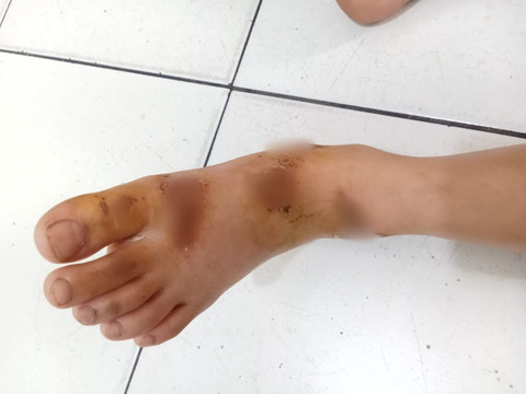 Kondisi luka siswi kelas 3 sekolah dasar yang terseret pelaku pencurian sejauh 20 meter, Medan, Selasa (13/1/2026). Foto: Dok. Pribadi