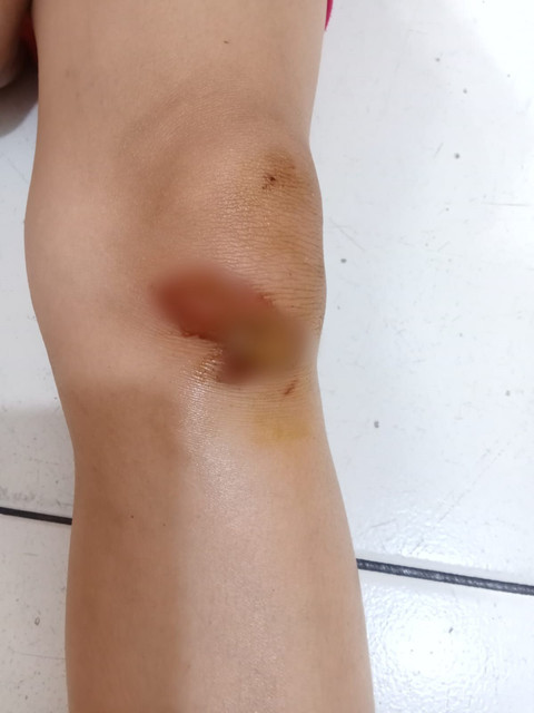 Kondisi luka siswi kelas 3 sekolah dasar yang terseret pelaku pencurian sejauh 20 meter, Medan, Selasa (13/1/2026). Foto: Dok. Pribadi