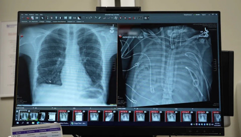 Paru-paru pasien saat akan menjalani transplantasi. Foto: Northwestern University