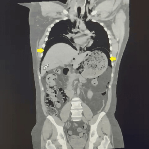 Pemindaian CT abdomen menunjukkan pneumoperitoneum (panah kuning). Foto: NCBI
