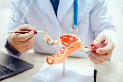 Kanker ovarium . Foto: SORASIT SRIKHAM-ON/Shutterstock