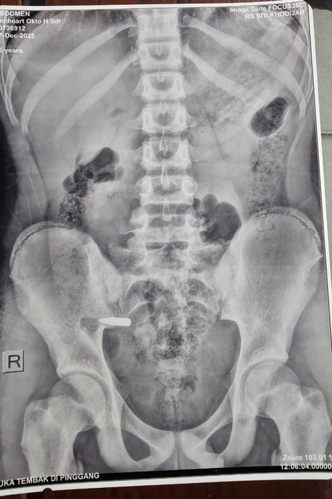 Hasil foto rontgen dari siswa SMP 33 Gresik yang terkena peluru nyasar. Foto: Dok. Istimewa