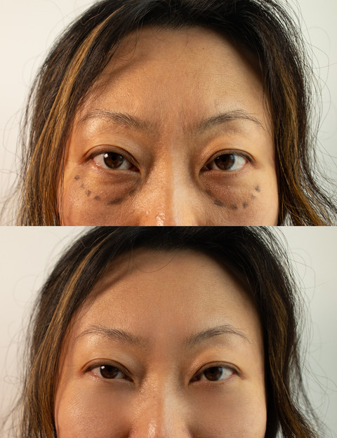 Ilustrasi operasi plastik facelift. Foto: Yanya/Shutterstock