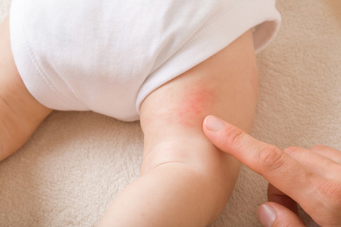 Ilustrasi tanda-tanda ruam pada bayi. Foto: FotoDuets/Shutterstock