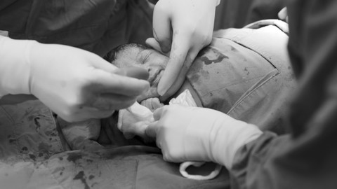 Ilustrasi Operasi Caesar. Foto: Naypong Studio/Shutterstock