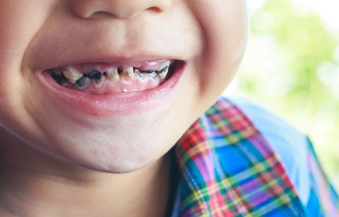 Ilustrasi karies gigi pada anak. Foto: Shutter Stock