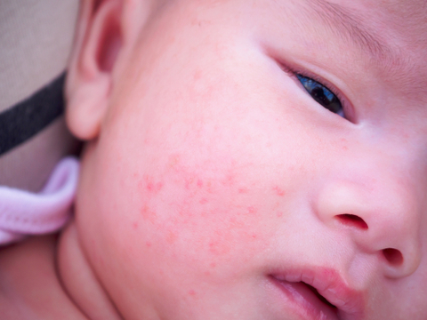 Dermatitis atopik pada bayi. Foto: Shutter Stock