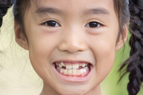 Ilustrasi gigi anak berjejal. Foto: Shutterstock