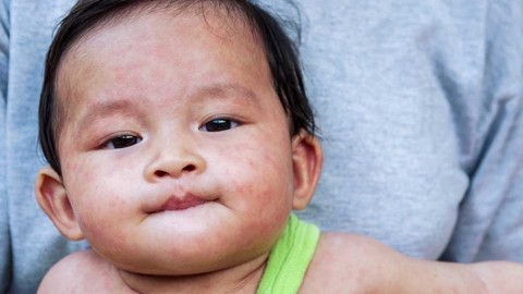 Perawatan Campak Pada Anak Paling Efektif Kumparan Com