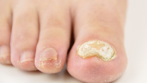 Ilustrasi infeksi jamur kuku. Foto: Shutter Stock