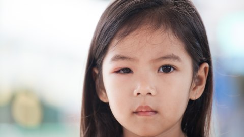Rhinitis Alergi Bikin Mata Anak Bengkak, Apakah Berbahaya? Foto: Thinkstock