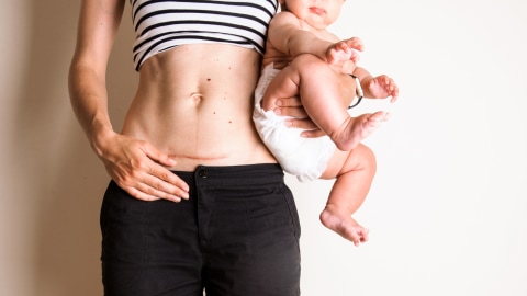 Ilustrasi bekas jahitan operasi caesar. Foto: Shutter Stock