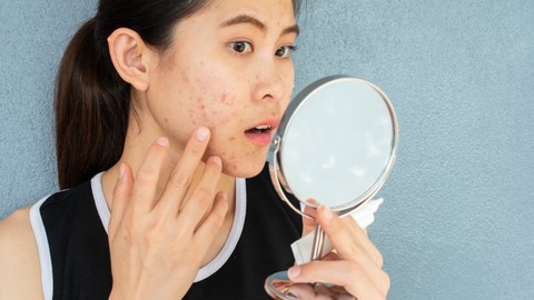 Ilustrasi kulit sensitif dan berjerawat. Foto: Shutterstock