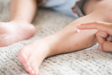 Ilustrasi menggunakan lotion calamine pada bayi.   Foto: Shutterstock