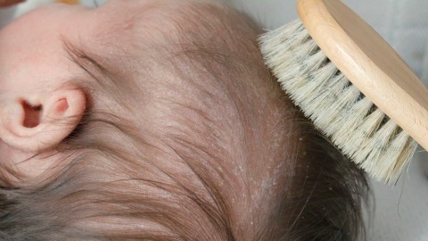 Ilustrasi cradle cap pada bayi. Foto: Shutter Stock