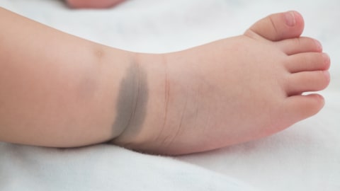 Mongolian spot - bercak biru pada kulit bayi Foto: Shutterstock