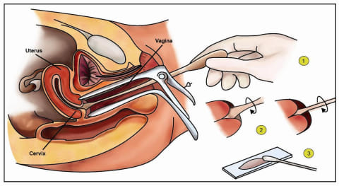 Penjelasan Soal Pap Smear Gratis Atau Berbayar Kumparan Com