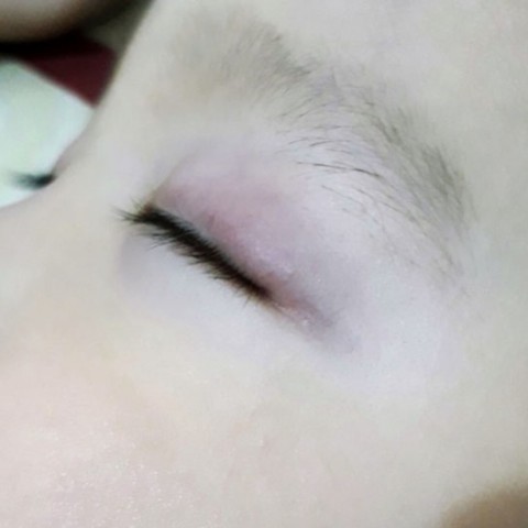 Bengkak Pada Kelopak Mata Anak Kumparan Com