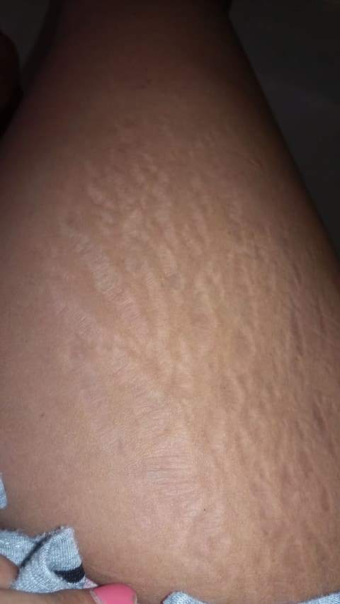 Korban Kosmetik Ilegal Muncul Stretch Mark Di Kulit Dan Harus Dilaser Kumparan Com