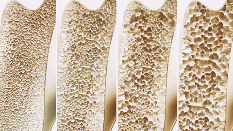 Osteoporosis Foto: Shutterstock