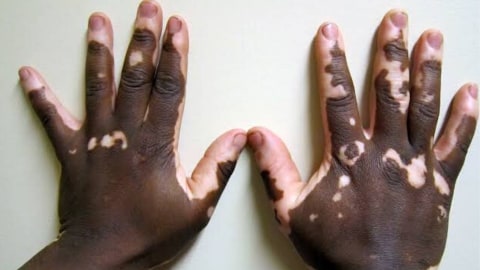 Mengenal Vitiligo Penyakit Kulit Yang Diidap Menristek Bambang Kumparan Com