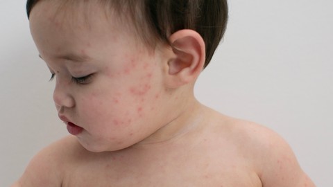 Risiko Campak pada Anak: Tidak Ada Perbedaan Disabilitas dan Non-Disabilitas