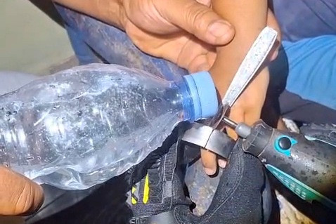 Jari Balita di Gunungkidul Kesangkut Tutup Botol, 