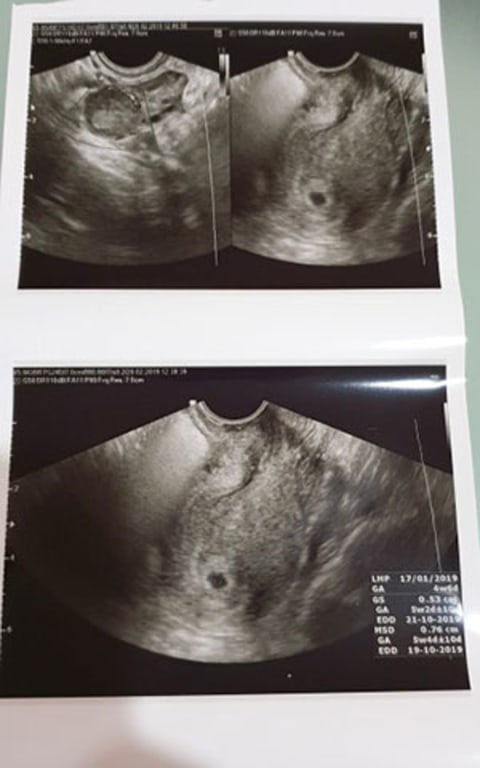 Kantung Janin Tidak Bulat Menyebabkan Flek Kumparan Com