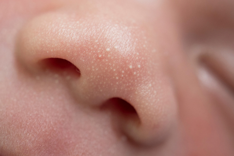 Milia pada bayi. Foto: Shutter Stock