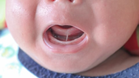 Tongue tie pada bayi. Foto: Shutterstock
