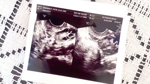 Pengalaman Pcos Ku Yang Berhasil Hamil Alami Kumparan Com Pengalaman Pcos Ku Yang Berhasil Hamil Alami Kumparan Com